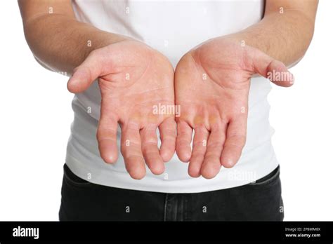 Man suffering from calluses on hands against white background, closeup ...