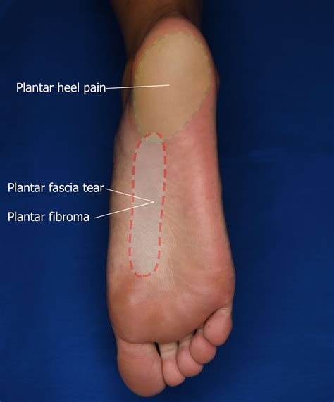 plantar fasciitis symptoms fitzroy foot  ankle clinic