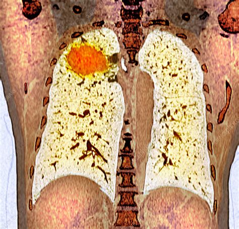 Lung cancer, CT scan - Stock Image - F041/8386 - Science Photo Library