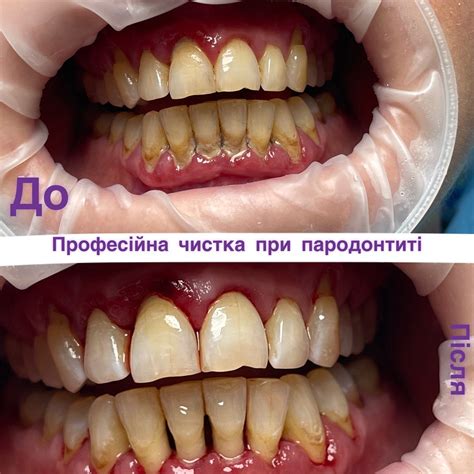 Професійна чистка зубів Air Flow - Ukrmed Clinic