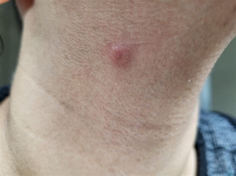 1749 best Pimple images on Pholder | Skincare Addiction, Acne and