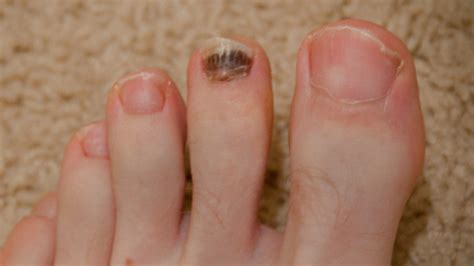 Toenail Thick Under Nail at Sharon Lyons blog