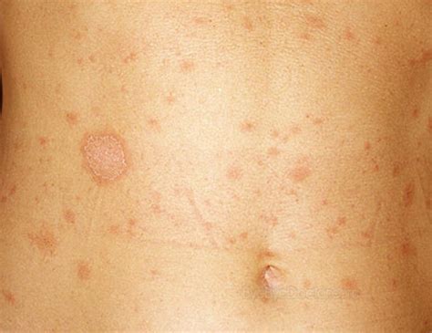 pityriasis rosea huid menselijk lichaam