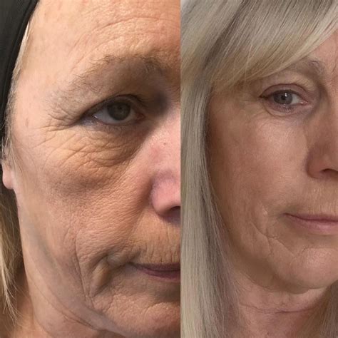 8 point face lift — SkinDeep Medical