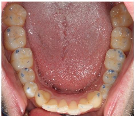 Occlusal Examination at Rose Collins blog