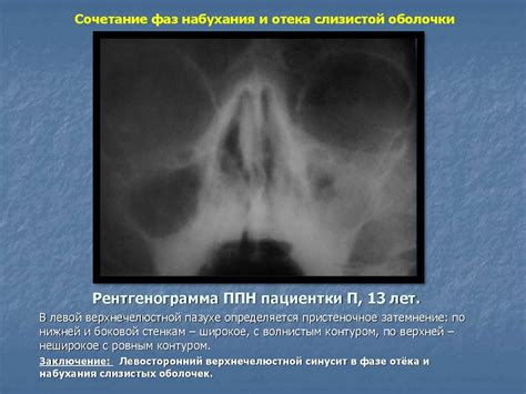 Рентгенографическая и компьютерно-томографическая диагностика острых и ...