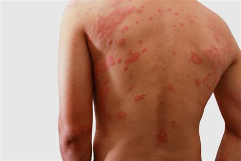 Symptoms and Causes of Polymorphic Light Eruption - Health & Detox ...