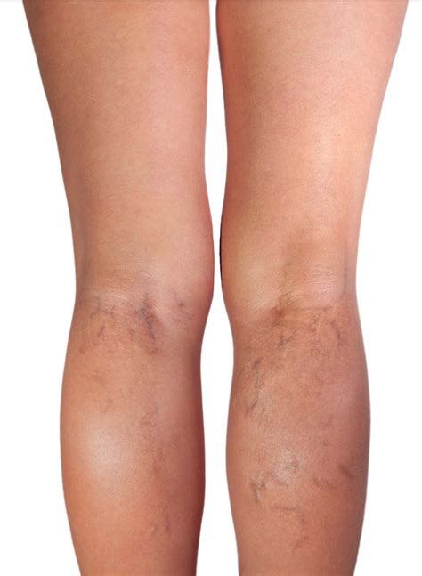 Get Rid of Varicose and Spider Veins Naturally with Horse Chestnut