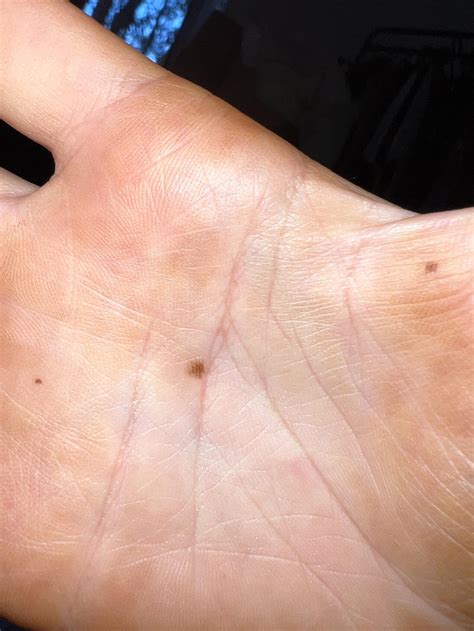 acral lentiginous melanoma rdermatologyquestions