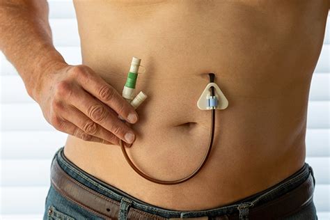 Feeding Tube Placement (PEG) – Dr. Kenneth Koo