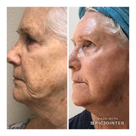 smartskin  laser prescott az skinplus medspa