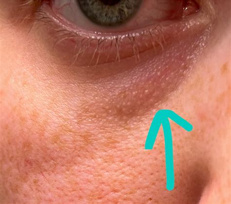 Is there anything to treat these small bumps in the bags under my eyes