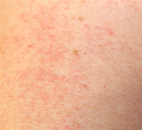 Unilateral Nevoid Telangiectasia Acquired Spider Unilateral Nevoid