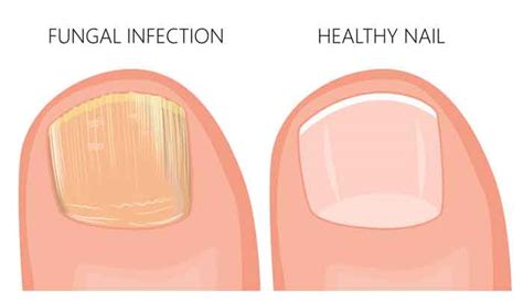 how long does it take a toenail to fall off