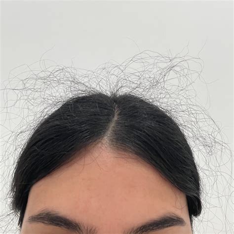 aftermath of telogen effluvium 🤣 : r/FemaleHairLoss