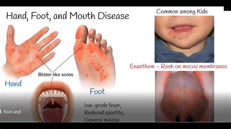 How Many Strains Of Hand Foot And Mouth Are There at Ethel Laskey blog