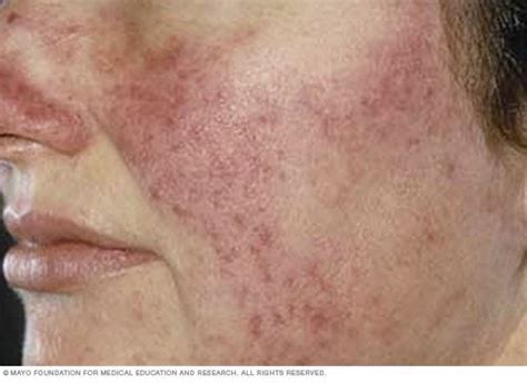 dr beals faad mohs surgery dermatology clinics  niceville andalusia