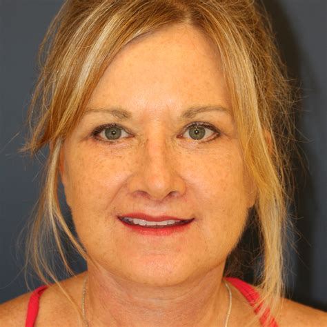 before and after lower face lift 7