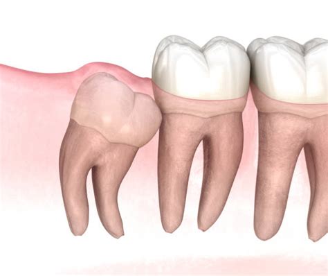 Mesial Angle Stock Photos, Pictures & Royalty-Free Images - iStock