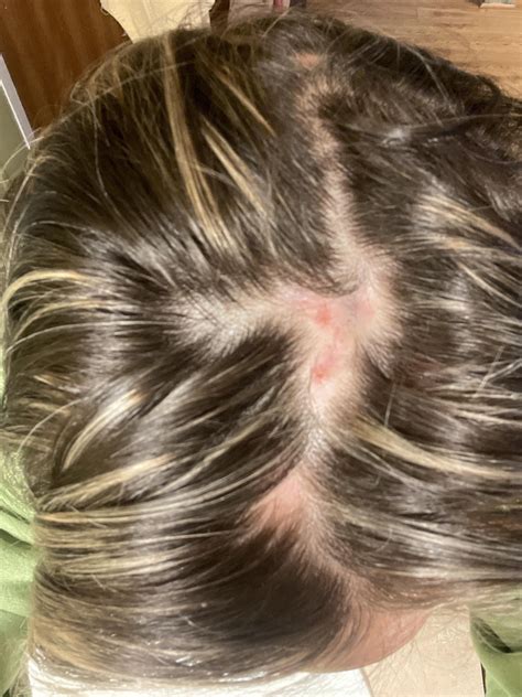 Needing help with possible discoid lupus erythematosus or some advice
