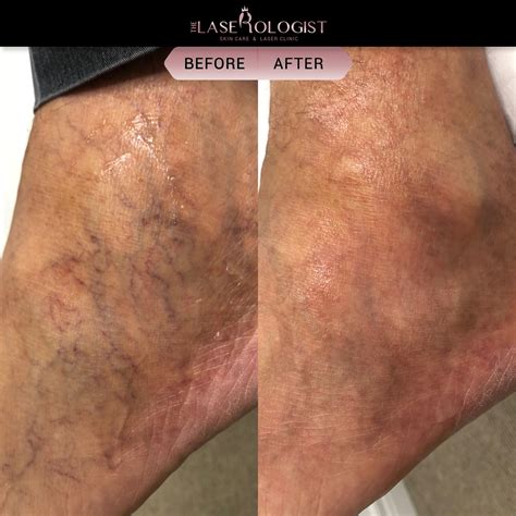 how to stop spider veins
