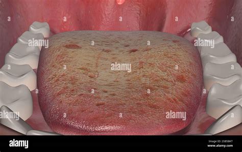 oral thrush fungal infection  tongue stock photo alamy