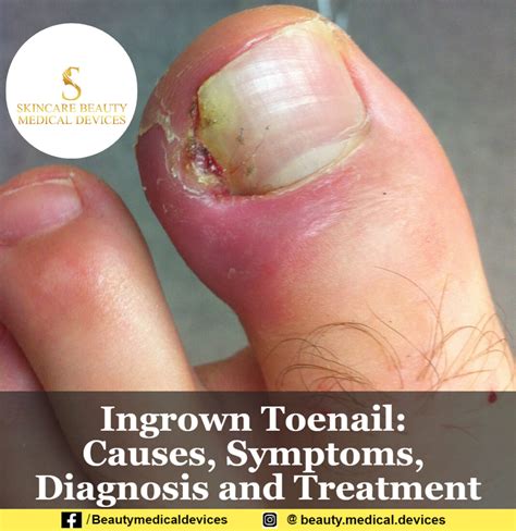 Ingrown Toenail: Causes, Symptoms, Diagnosis and Treatment