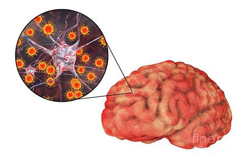 Viral Encephalitis Photograph by Kateryna Kon/science Photo Library ...