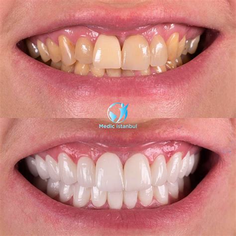 Buck Teeth: Remedies and Causes - Medic istanbul