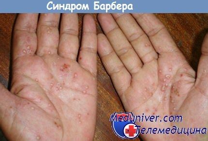 Синдром Барбера (Barber) - синонимы, авторы, клиника