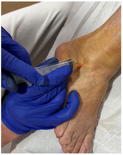 Platelet-Rich Plasma Injections in Chronic Lateral Ankle Instability: A