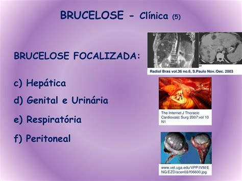Brucelose Sintomas Em Humanos