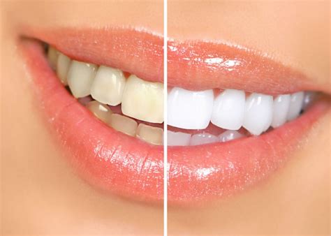 teeth whitening bleaching rainbow dental clinic