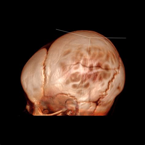 Infant with left parietal soft tissue swelling | Pediatric Radiology