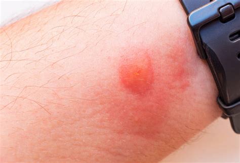 Deer Fly Bites On Humans
