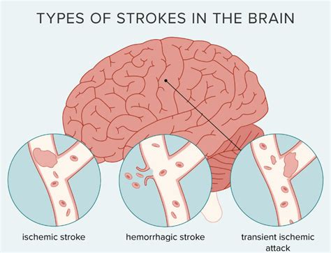 types  stroke public health notes