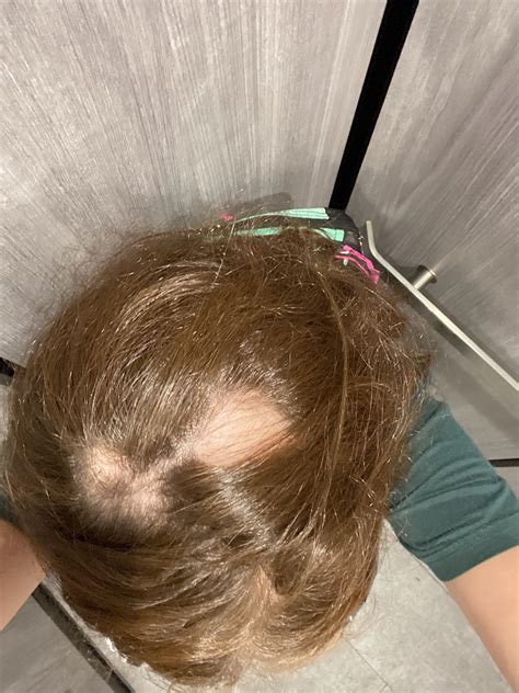 bald on top hair on sides 4