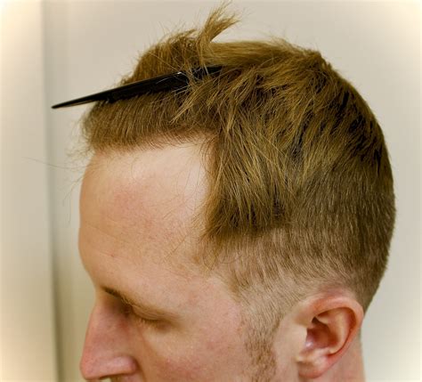 Hairline restoration surgery for a big forehead will grow in 2026 18