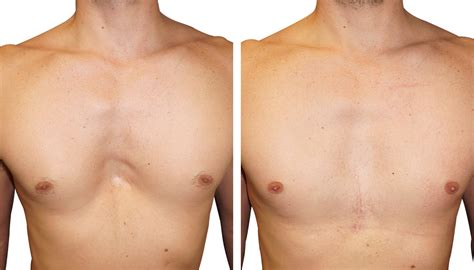 Pectus Excavatum Erfahrungen , Trichterbrust OP – PCCY