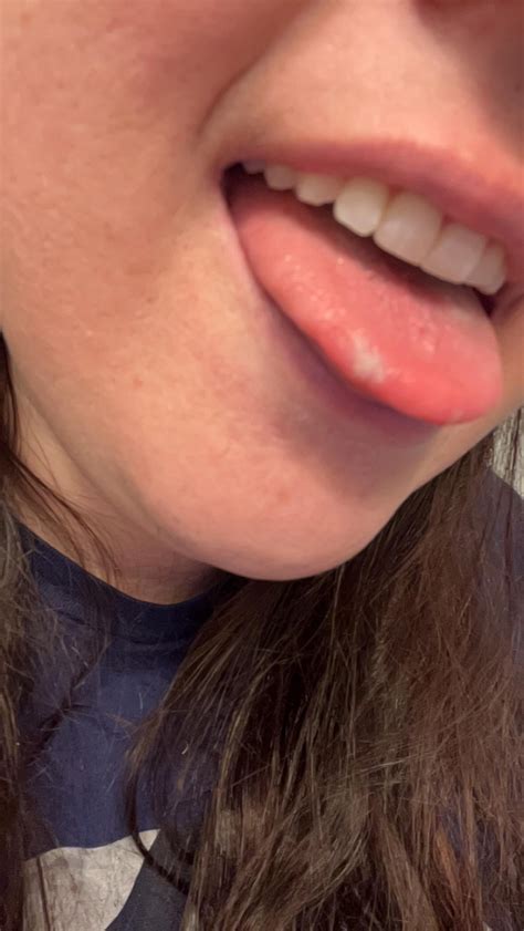 White painful spot on tongue? : r/CankerSores