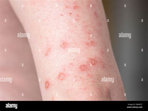 Syphilis rash hi-res stock photography and images - Alamy