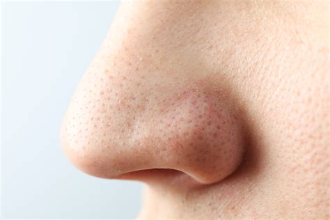 Doctor Reveals The Best Unbelievable Blackhead Removal 2024 Technique. Image 18