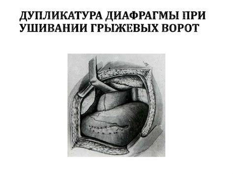Диафрагмальные грыжи - презентация онлайн