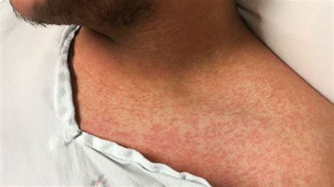 chemo rash  pictures treatment  prevention