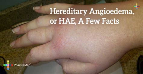 hereditary angioedema  hae   facts