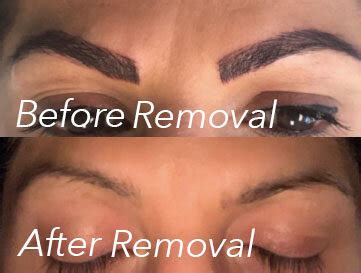 Eyebrow Semi Permanent Makeup Removal | Saubhaya Makeup