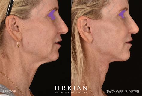 face  neck lift dr kian