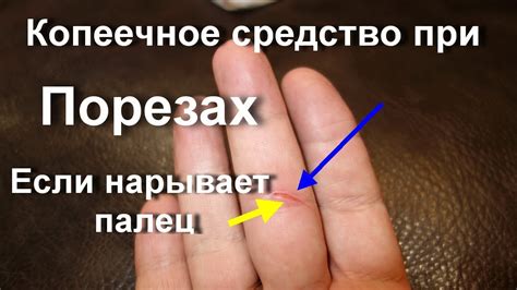 Как я лечу за 1 день воспаление и гнойный нарыв на пальце. Быстро Легко ...