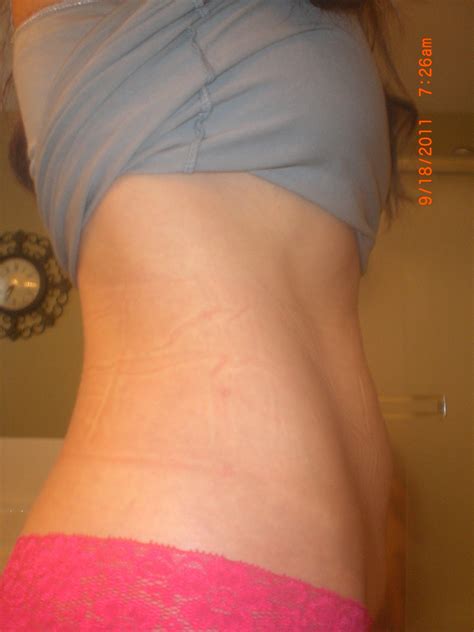 NEW! BEFORE and AFTER Diastasis Recti Pictures and results with Tupler