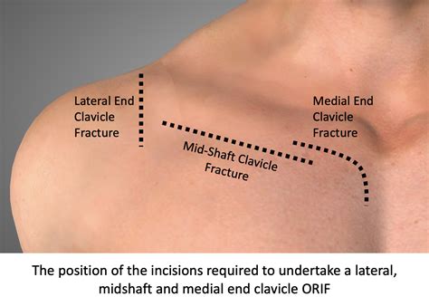 Clavicle – Cambridge Shoulder